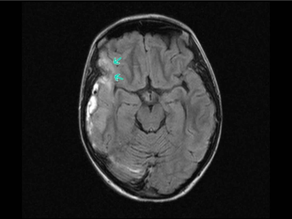 Магнитно-резонансная томография (МРТ) головного мозга